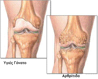 Ολική Αρθροπλαστική του Γόνατος