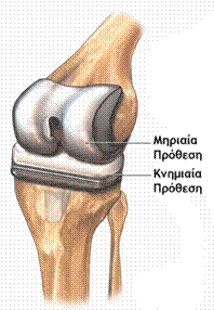 Ολική Αρθροπλαστική του Γόνατος